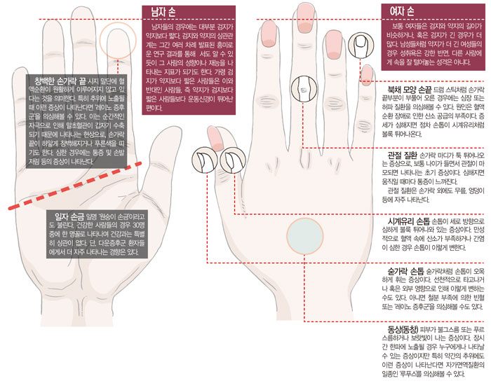 [해외건강정보] 손을 보면 건강 보인다
