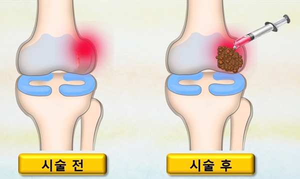 70대 무릎관절! 20대 무릎관절로...줄기세포 치료술 화제