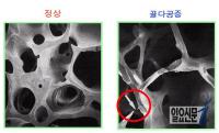 ‘비타민D 결핍’ 주의보, 내 몸의 ‘뼈 구멍’ 경보