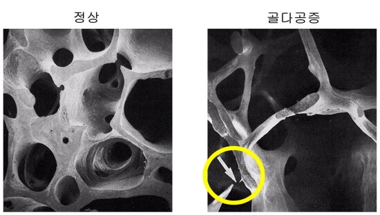 골다공증 증상 비교 예시 이미지. 사진=대동병원 제공