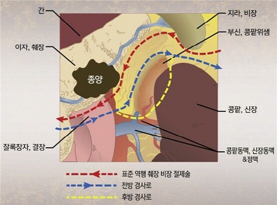 ‘복강동맥 침범한 췌장암’ 이미지. 사진=온종합병원 제공