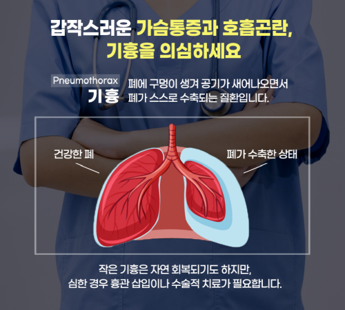 ‘폐 기흉’ 참고 이미지. 사진=온병원 제공