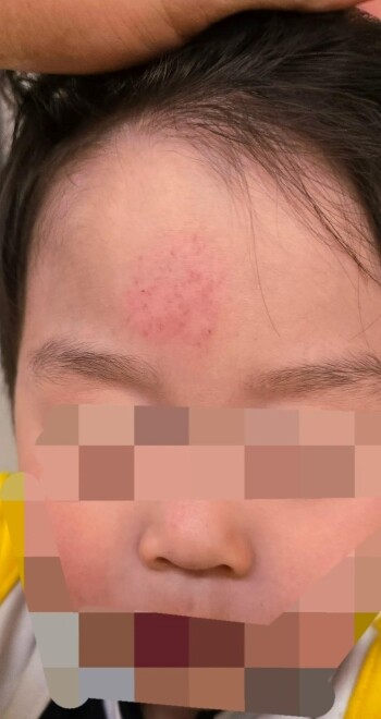 피해 아동이 이마에 타박상을 입은 모습. 사진=SNS 갈무리